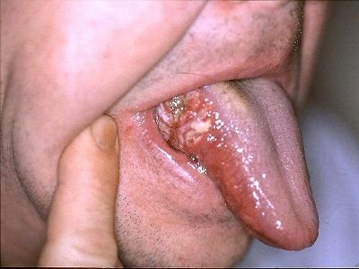 tongue_cancer.jpg