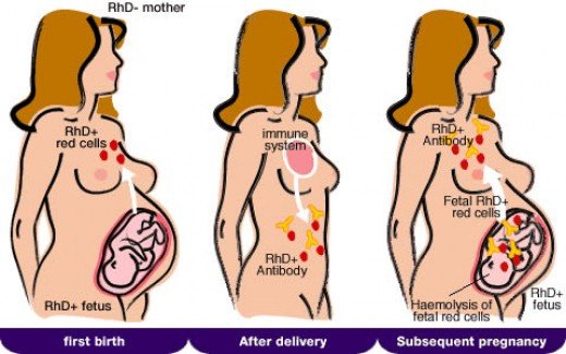 Summary of rhesus disease.jpg