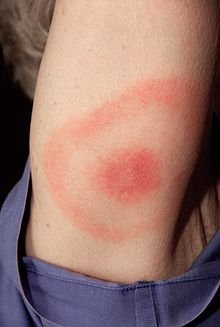 Erythema_migrans_-_erythematous_rash_in_Lyme_disease_-_PHIL_9875.jpg