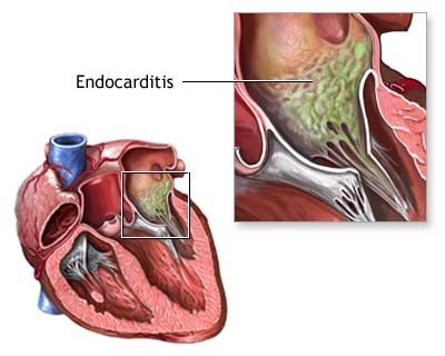 Infective-Endocarditis-Duke-diagnostic-criteria.jpg