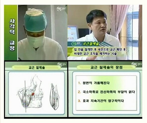 교근축소술 전후.jpg