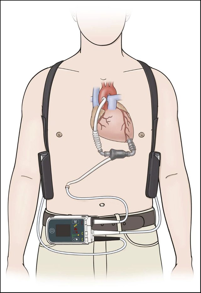 Ventricular Assist Devices.jpg