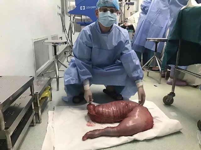 doctors-at-shanghai-tenth-peoples-hospital-removed-nearly-30-pounds-of-feces-from-a-22-year-old-man.jpeg