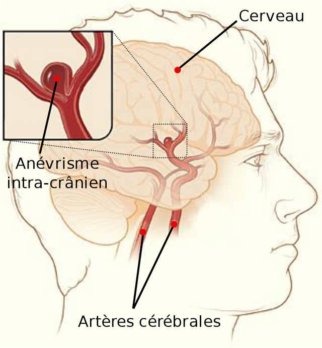 Cerebral_aneurysm-fr.svg.png