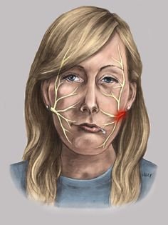 df91b0d281d303a90a9eeb1dbc2597ea--facial-nerve-bells-palsy.jpg