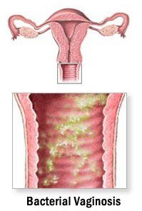 bacterial-vaginosis-symptoms.jpg