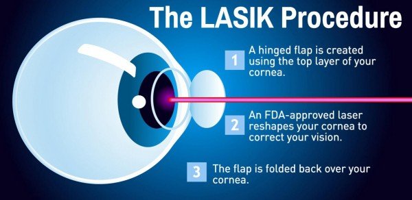 lasik procedure single eye.jpeg