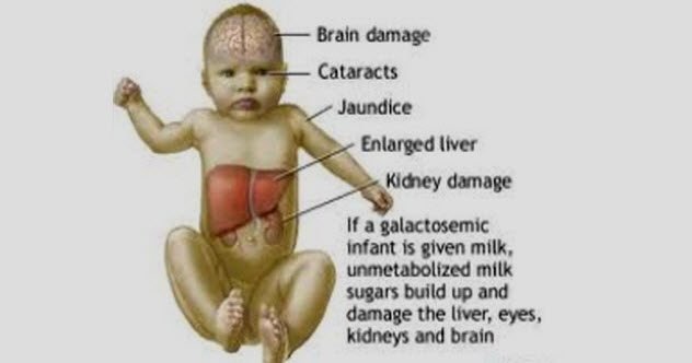 4b-msud-symptoms.jpg