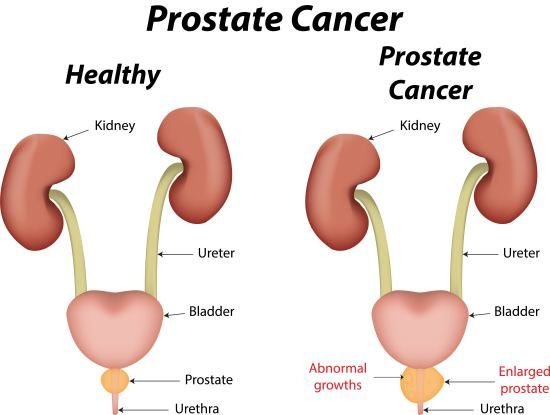 prostate cancer 3.jpg