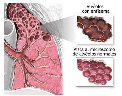 enfisema-pulmonar-definicion.jpg