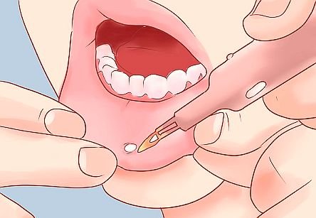 Mouth Ulcers Drugs.jpg