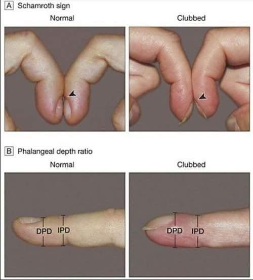 How To Know If You Have A Heart Disease Using Only With Fingers And Nails Steemit