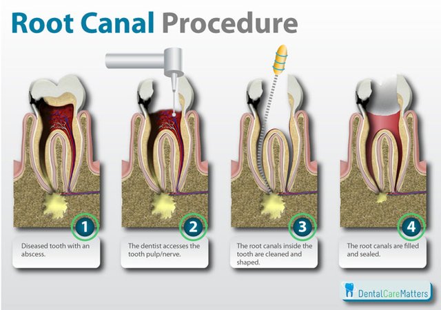 Root-canal-procedure.jpg