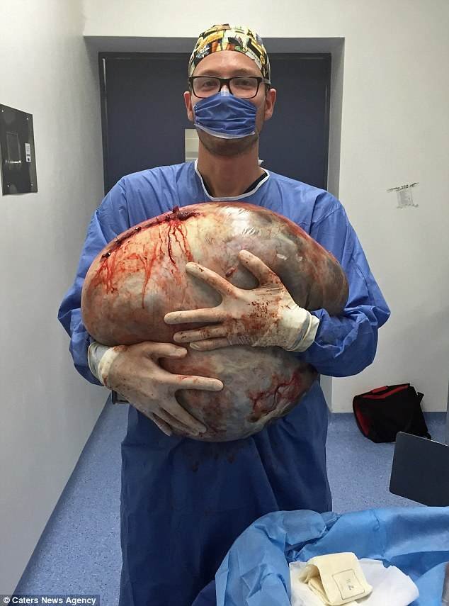 33-kg cystectomy in a young girl!.jpg