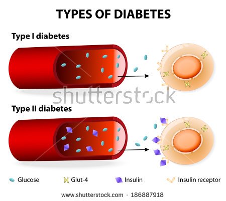stock-vector-types-of-diabetes-type-and-type-diabetes-mellitus-insulin-dependent-diabetes-mellitus-and-non-186887918.jpg