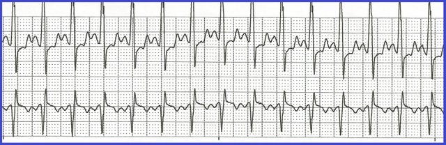 Sinus tachycardia.jpg