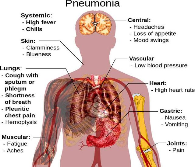 Pneumonia.jpg