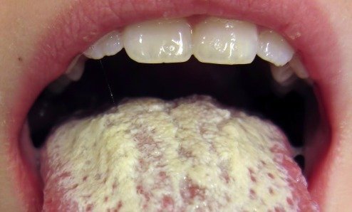 Candida-Albicans-on-the-tongue.jpg