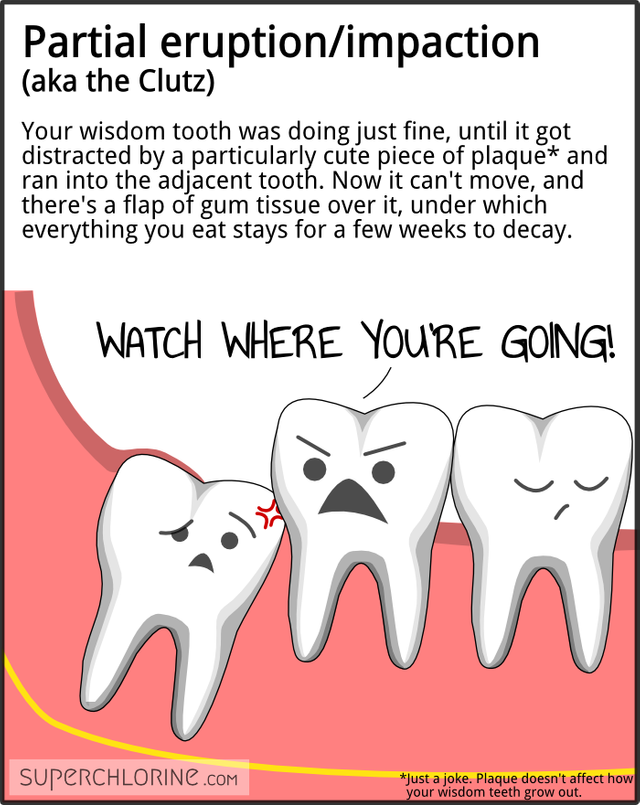 wisdom-teeth-types_partial-erupt.png