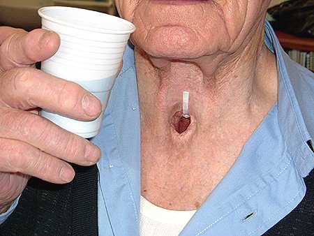 Laryngeal-Cancer.jpg