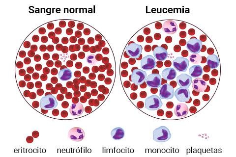 tipos-de-leucemia.jpg