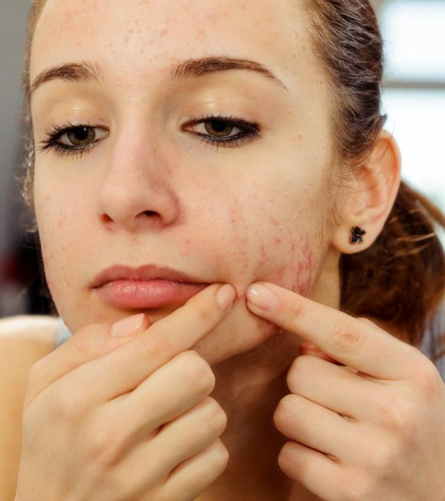 3161_21-Simple-Tips-To-Control-Acne-In-Teenagers_iS.jpg