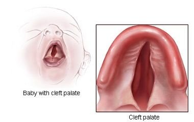 isolated Cleft palate.jpeg