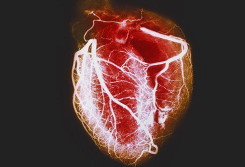 heart-disease-visual-guide-s1-arteriogram-of-healthy-heart.jpg