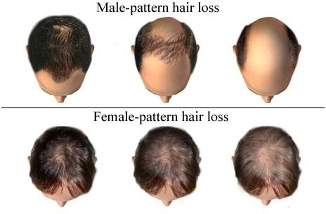 hair-loss-prp-hair-prp-hair-traetment-bald-head-hair-treatment-without-hair-transplant-hair-treatment-india-hyderabad-mumbai-prp-for-hair.jpg