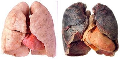 lung-cancer.jpg