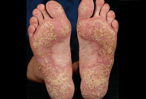 psoriasis-vulgaris-soles-3-5.jpg