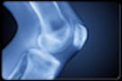 osteoarthritis-overview-s1-xray-knee.jpg