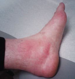 Gout-in-ankle.jpg