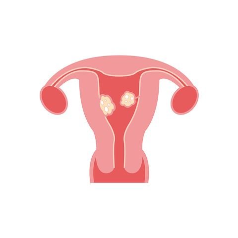 fibroids-2947712__480.jpg