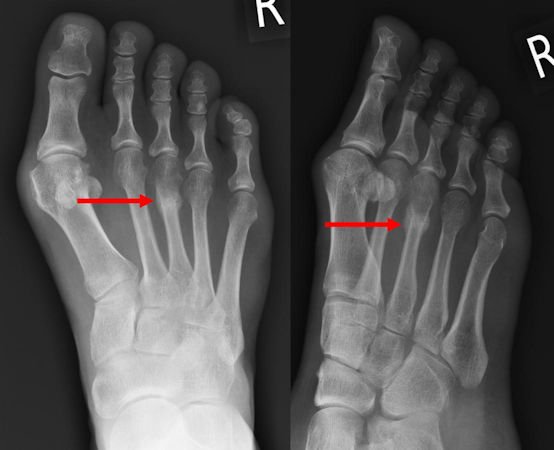 stress fracture foot2.jpg