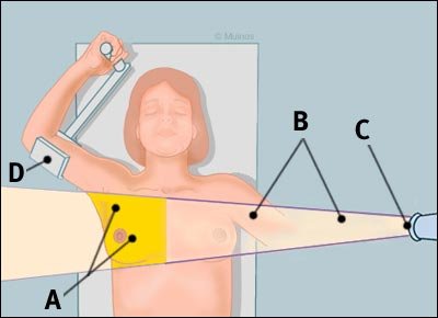 radiation_treatment1[2]_tcm8-79394.jpg