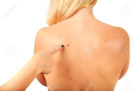 birthmark real.jpg
