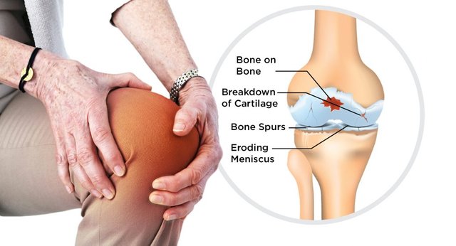 http___www.kauveryhospital.com_blog_wp-content_uploads_2017_09_Osteoarthritis.jpg