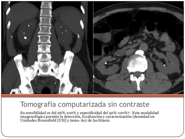 nefrolitiasis-16-638.jpg