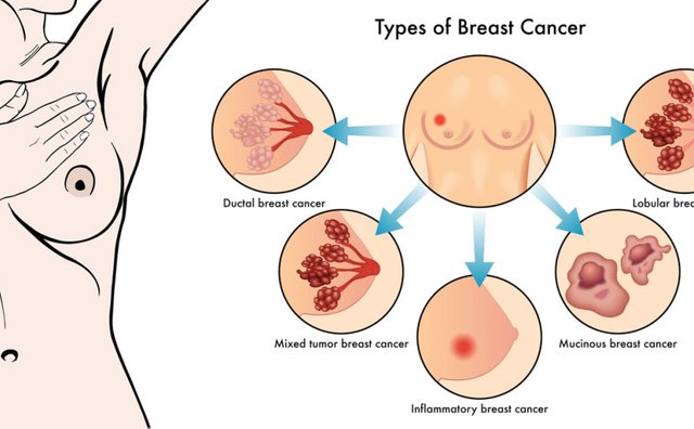7_Breast-Cancer-825x510.jpg