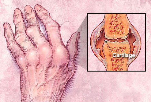 Rheumatoid-arthritis-hand.jpg