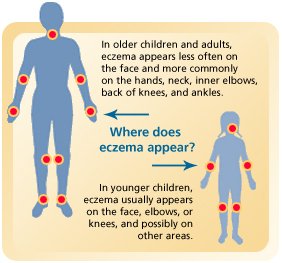 11243538-how-to-cure-eczema-at-homefastnaturally.jpg