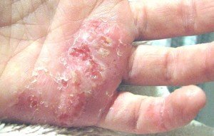 eczema infections.jpg