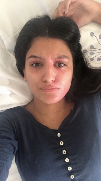 1504856447_304_Acid-Attack-Survivor-Shares-How-She-Looks-Like-Without-Makeup-After-Viral-Post-Recovery-Tweet.jpg