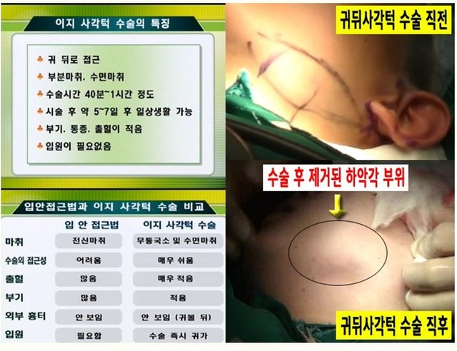귀뒤사각턱 붓기.jpg