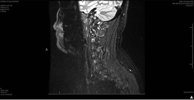 cervical 2.jpg