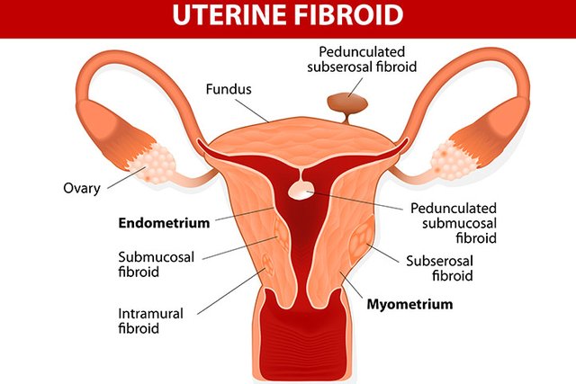 uterine-fibroids-and-pregnancy.jpg