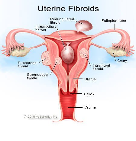 uterine-fibroids.jpg