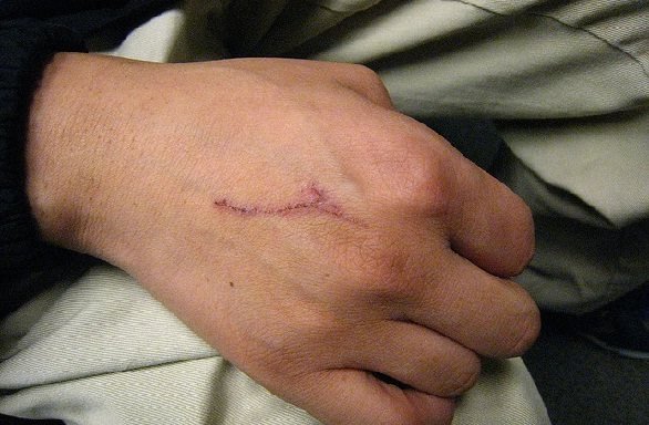 Babool-Leaves-for-Wounds-in-Hindi.jpg