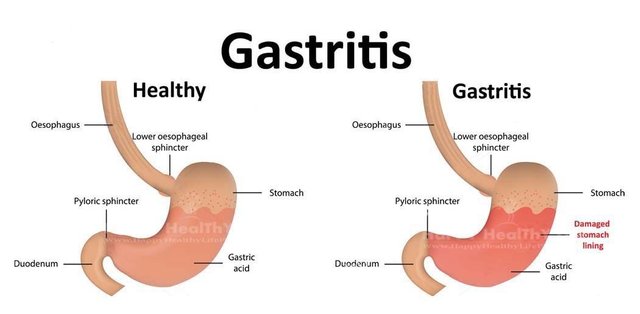 Gastritis.jpg